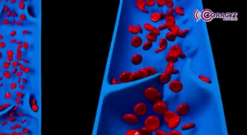 La trombosis puede ser mortal si no se detecta a tiempo: Issste Tlaxcala